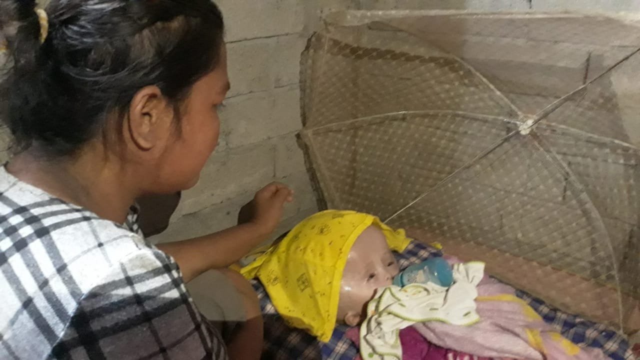 Bayi 6 Bulan Penderita Hydrocephalus di Parimo Butuh Uluran Tangan