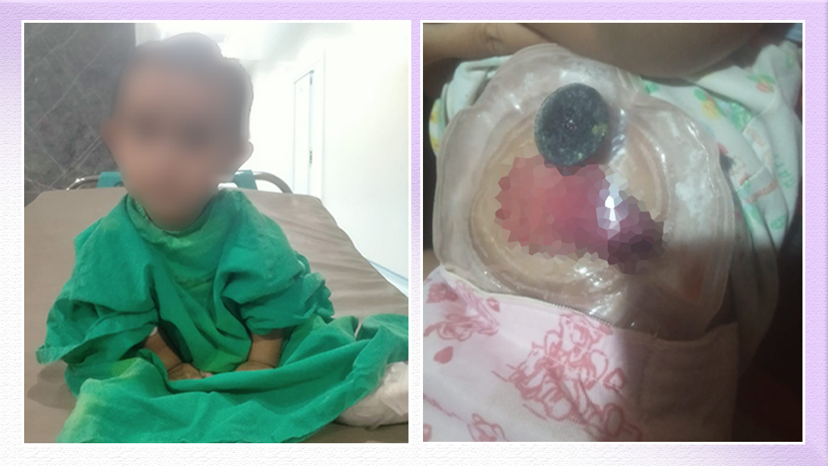 Segera Jalani Operasi Ketiga, Bayi Senja Kembali Butuh Bantuan Dermawan